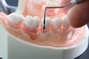 歯周病のイメージ
